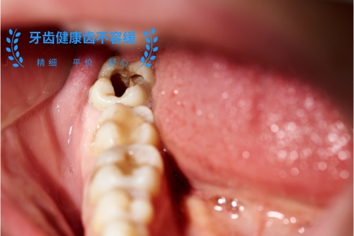 合肥补牙多少钱、补牙