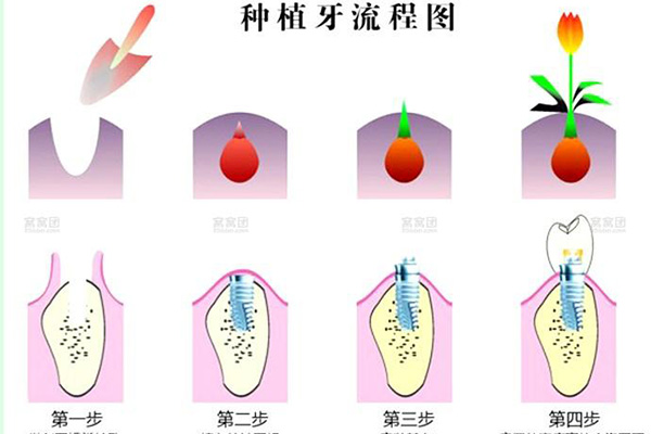 合肥种植牙齿需要多少钱