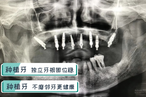 合肥种植牙价格